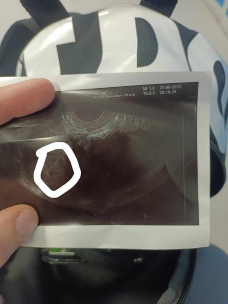 Je dutinka v 5. týdnu těhotenství normální nález?