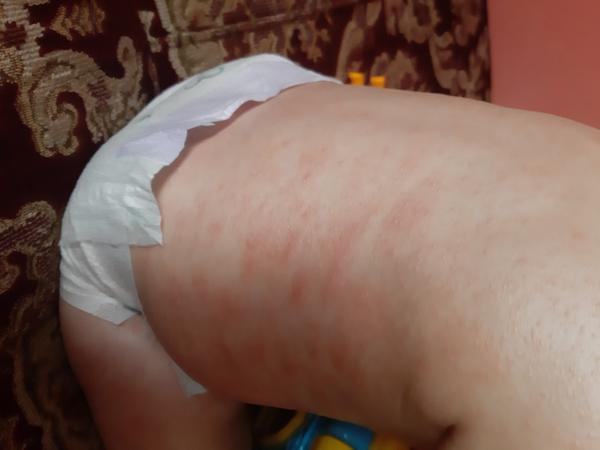 Ekzém. Jaký produkt byste doporučila?