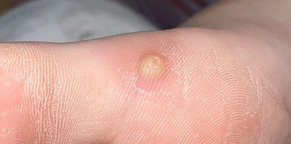 Je to bradavice nebo kuří oko?