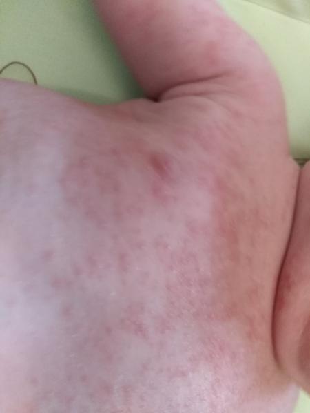 Ekzém, kvasinka. Poradíte mi prosím, co s tím, čím mazat a jak postupovat?