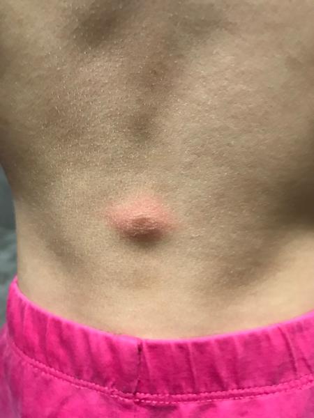 Vyrážka na zádech u dcery. Jak zjistit příčinu?