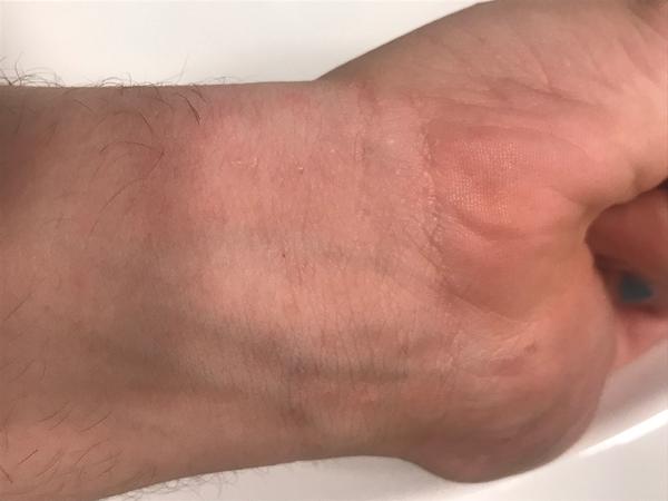 Svědivá kožní vyrážka: Co může být příčinou?