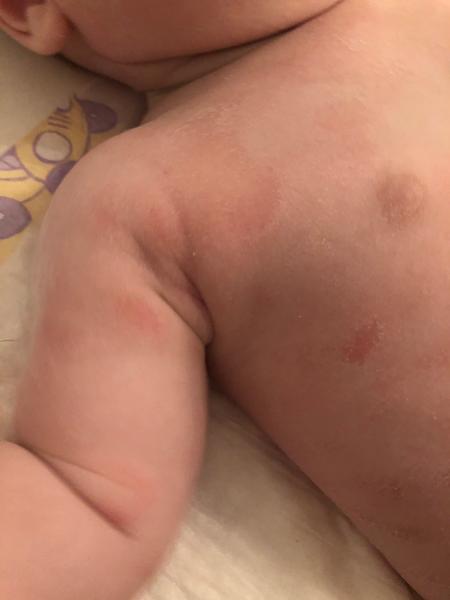 Ekzém nebo kvasinka. Jak a čím pokračovat v léčbě?