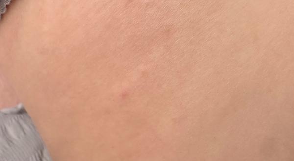 Svědivé puchýřky na těle. Je to svrab nebo alergie?