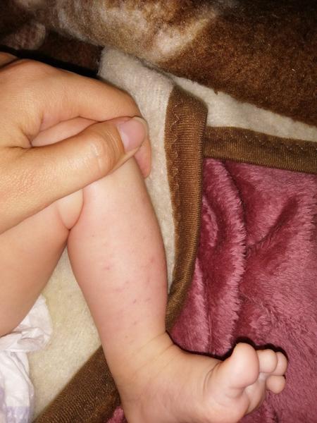 Fleky na nohou 3. měsíčního kluka. Co by to mohlo být?