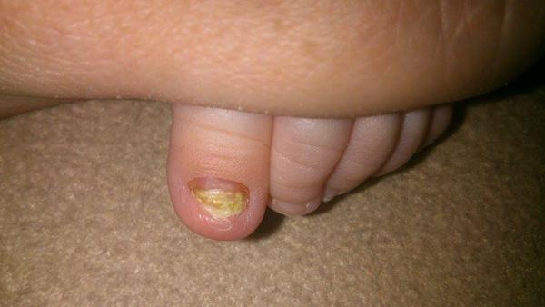 Zdeformovaný nehet u miminka, co s tím?