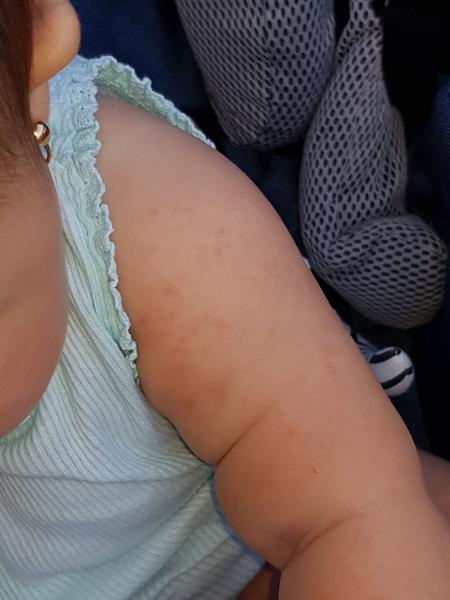 Foto - je to vyrážka nebo potničky?