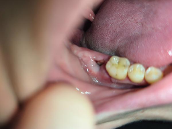 Rána po extrakci zubu. Je to takto v pořádku?