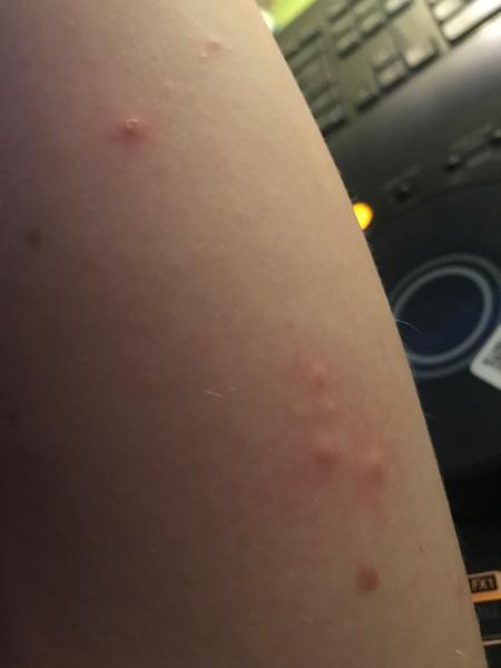 Svědivá kožní vyrážka: Co může být příčinou?