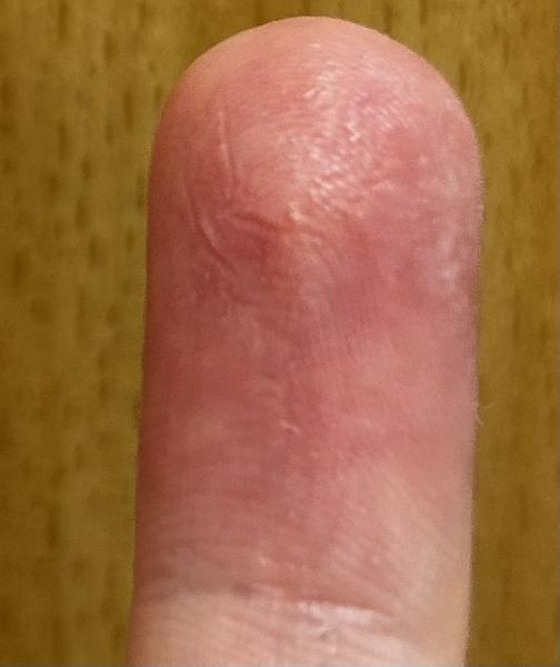 Vodnaté pupínky a zarudlý flek na prstu: Příčiny?