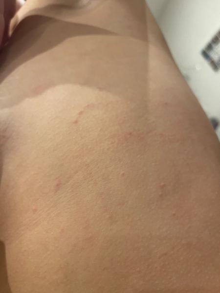 Vyrážka. Co by to mohlo být?