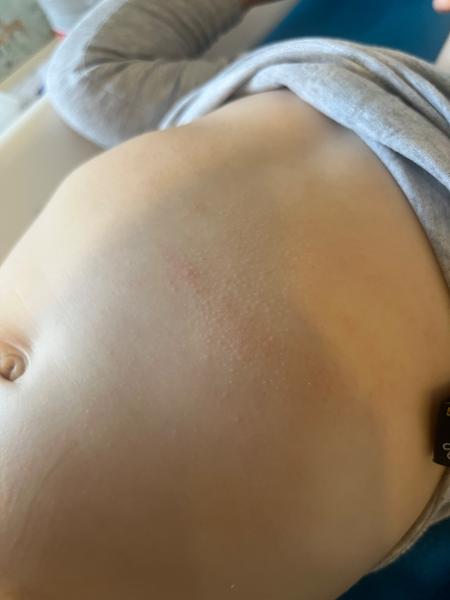 Zkušenosti s ekzémem u dětí a doporučené přípravky