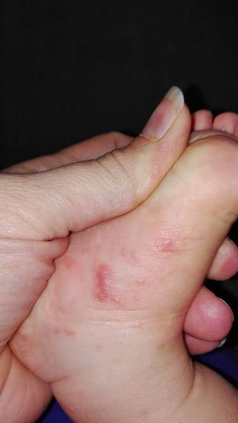 Alergie na mrkev u 11měsíční holčičky?