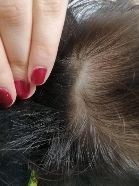 Jak rozpoznat hnidy na suché pokožce syna?