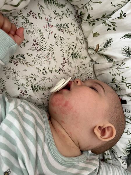 Co je to za vyrážku?