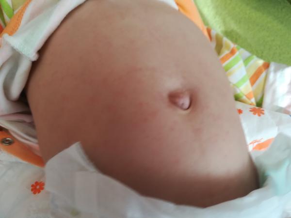 Vyráža u půlročního syna - co to může být?