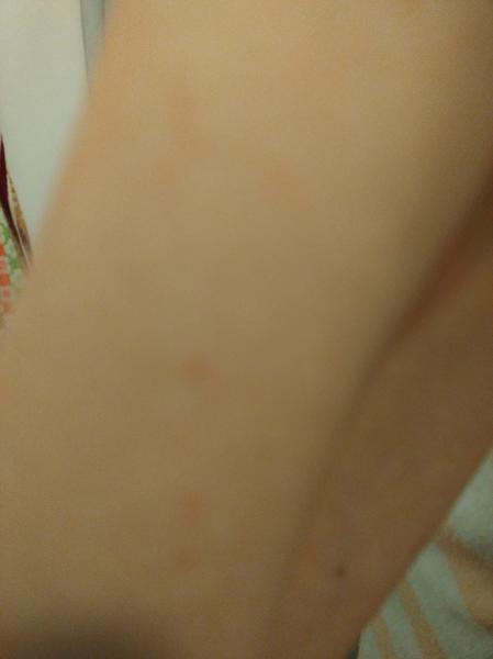 Pupínky na zápěstí. Je to alergie nebo svrab?