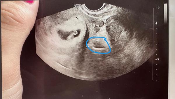 Co se nachází na ultrazvuku v modrém kroužku?