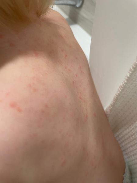 Alergická reakce dítěte na Amoxicillin. Jak pomoci?