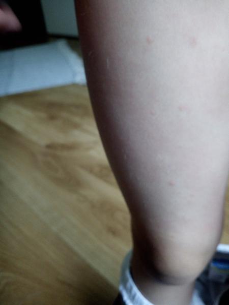 Mohou to být pupínky ze slunce?