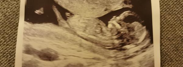 Je to pindík na ultrazvuku ve 14. týdnu?
