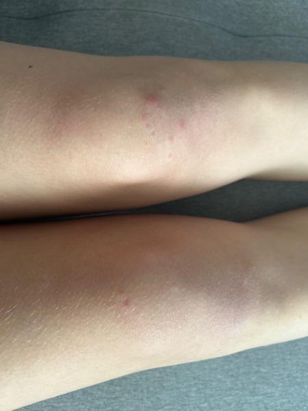 Červené pupínky po těle. Co by to mohlo být?