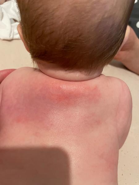 Ekzém nebo kvasinka?