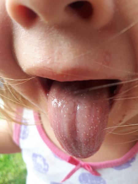 Vyrážka na zádech a břichu. Může to být spála?