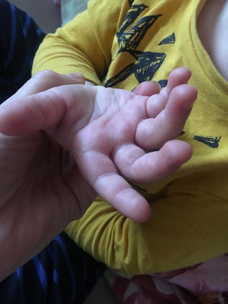 Ekzém u 3 letého dítěte. Hodně se škrábe a kortikoidy nepomáhají. Co více zkusit?