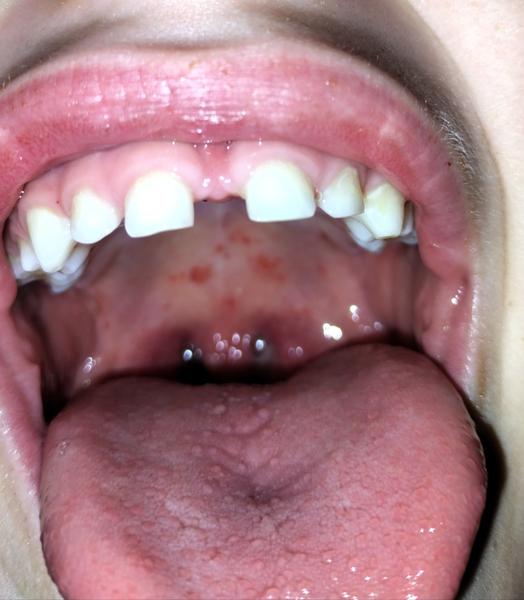 Kdy jet na pohotovost s angínou a horečkou?