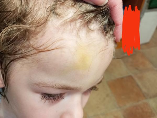 Za jak dlouho zmizí dětská boule na čele?