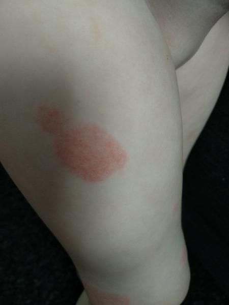 Je to ekzém? Dcera má fleky po celém těle