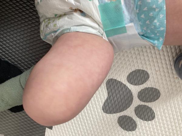 Mramorová kůže u dětí. Zvážit návštěvu pohotovosti?