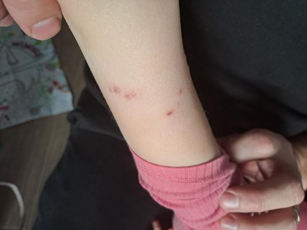 Puchýřky u dítěte. Může jít o alergickou reakci?