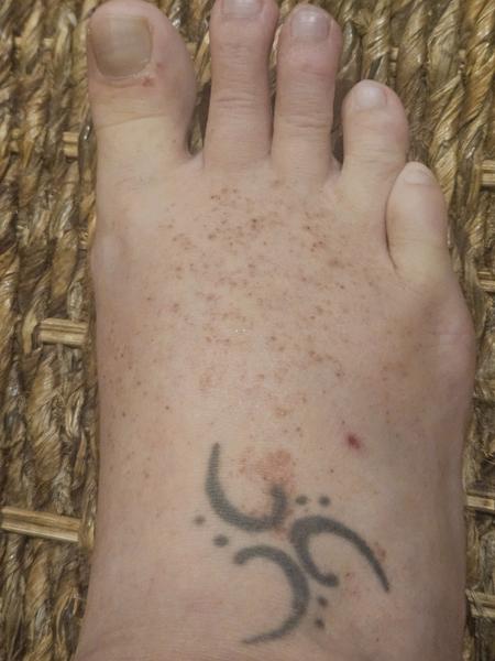 Proč kortikoidy nepomáhají na dermatitidu?