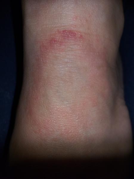 Červený flek na nártu. Borelióza, mykóza nebo něco jiného?