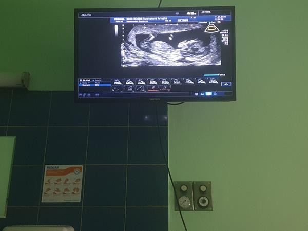 Fotka z prvního screeningu. Tipnete pohlaví miminka?
