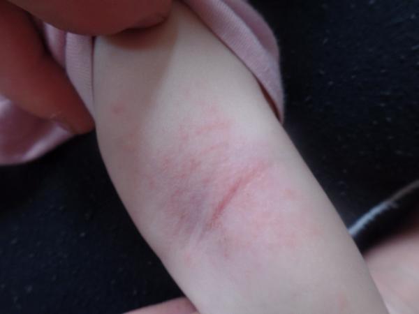 Ekzém v loketní jamce. Jak ošetřovat a jaká opatření zavést?