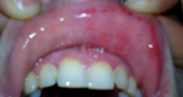 Bolest v krku při polykání, červené puchýřky