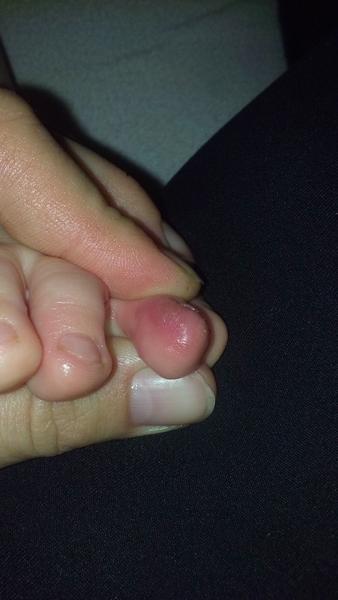 Plíseň na nožkách