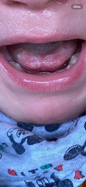 Afty u 2letého. Je možné, aby se mu po tak krátké době od injekcí B12 opět vrátily?