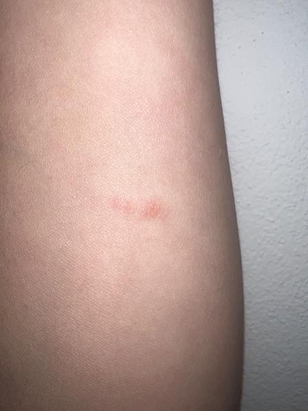 Pasový opar v těhotenství. Jaké jsou příznaky a rizika?