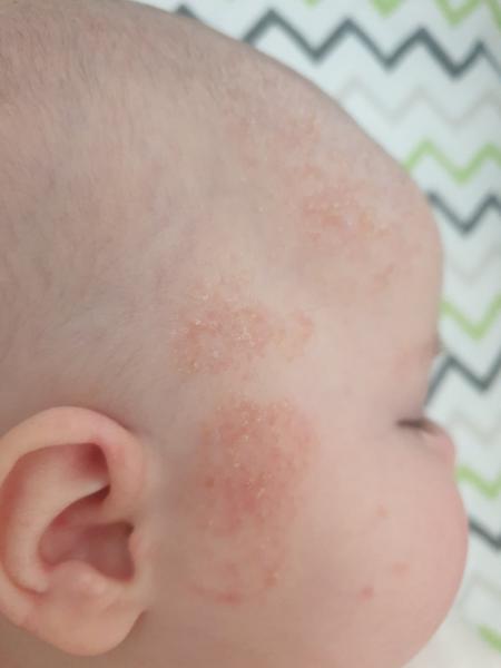 O jakou vyrážku se může jednat?