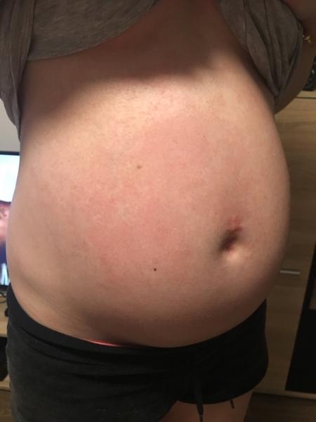 Vyrážka v těhotenství na prsou a břiše