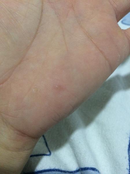 Pupínky - vodnaté puchýřky, objevují se stále dokola