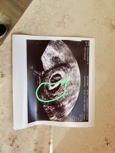 Máte zkušenosti s hematomem kolem dělohy? Jak se léčil?