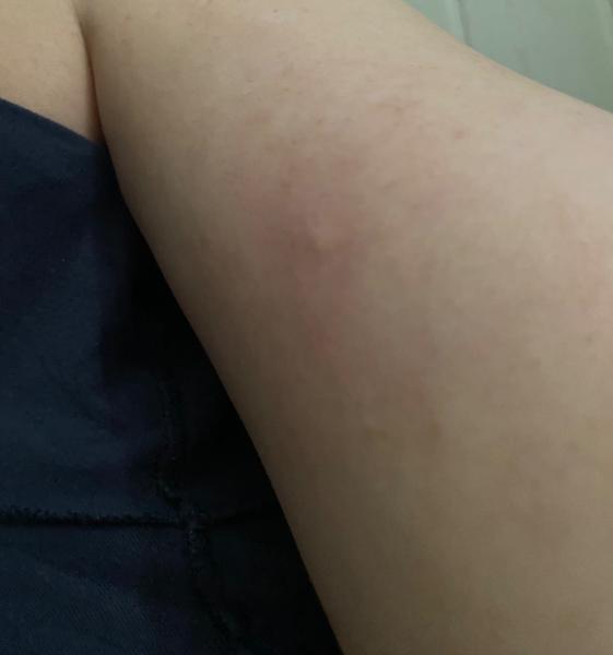 Možné příčiny štípanců na těle během zimy?