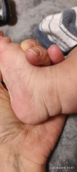 Jak pomoci miminku s vyrážkou a ekzémem?