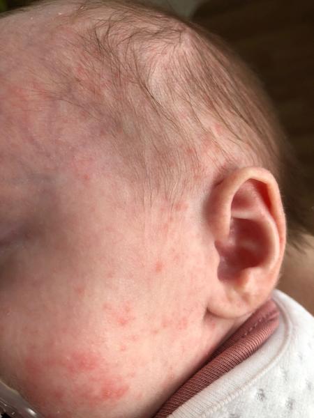 Vyrážka. Co dělat?