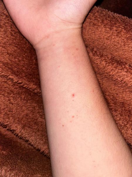 Jak rozpoznat svrab?